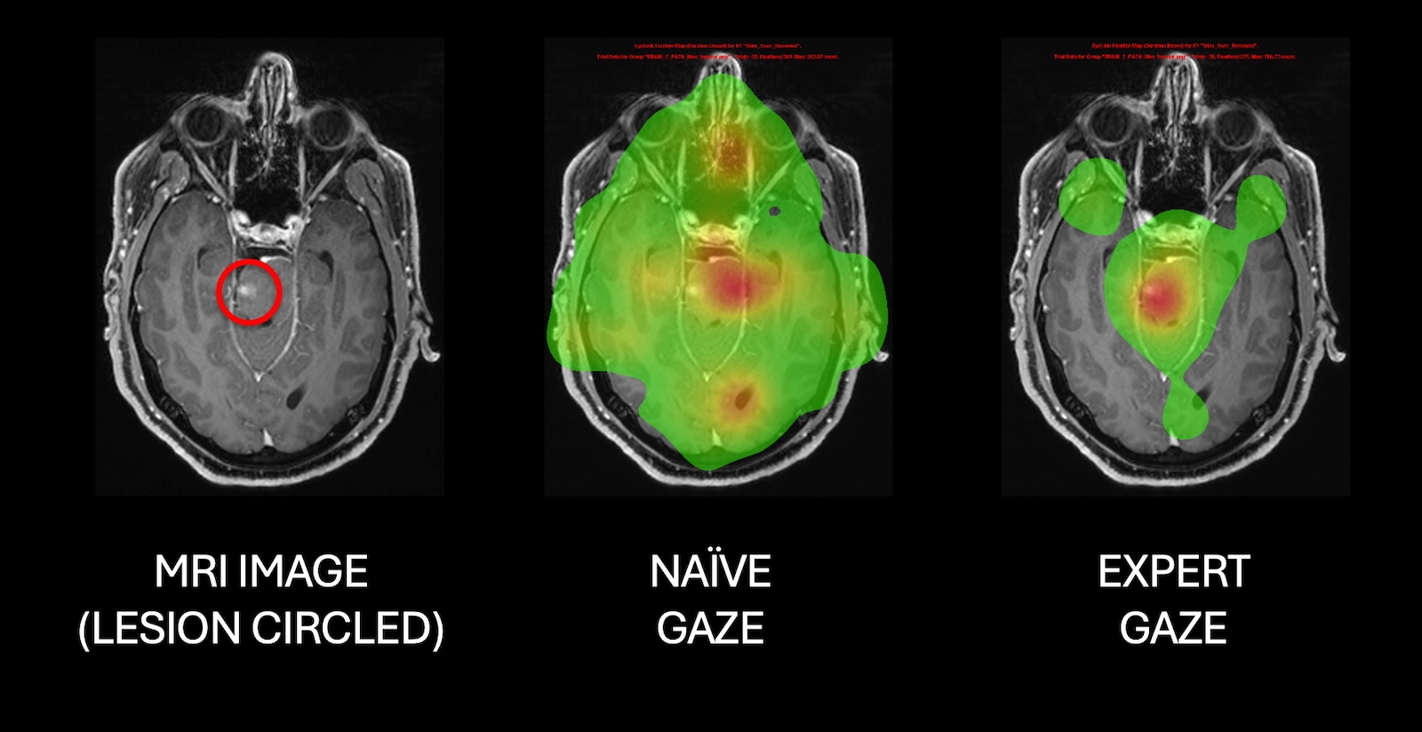 Neuro heat map