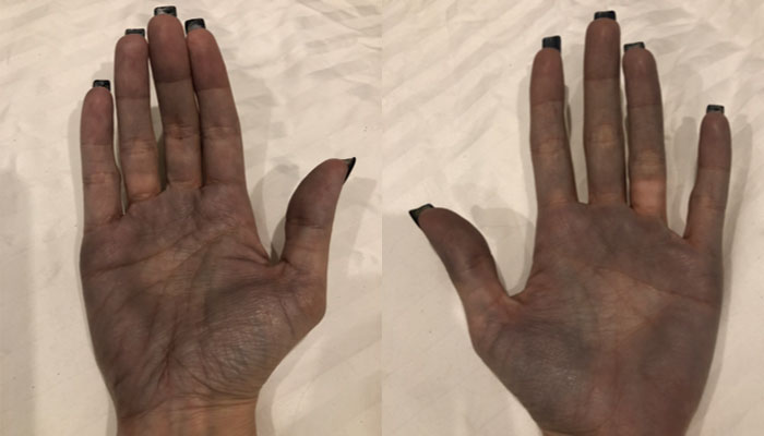 Shelley's hands were mysteriously discoloured before having her breast implants removed.